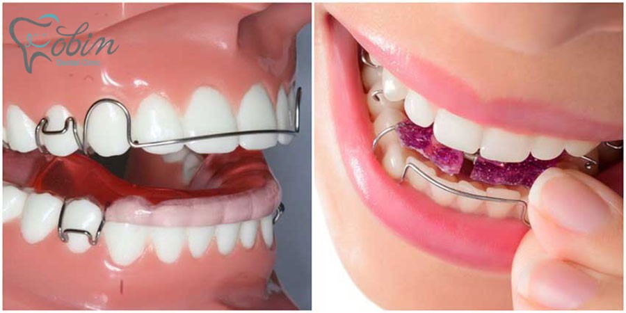 دندانپزشک قبل از هر گونه فعالیتی در زمینه ی ارتودنسی ، ابتدا باید یک عکس مناسب و کلی از دندان ها داشته باشد
